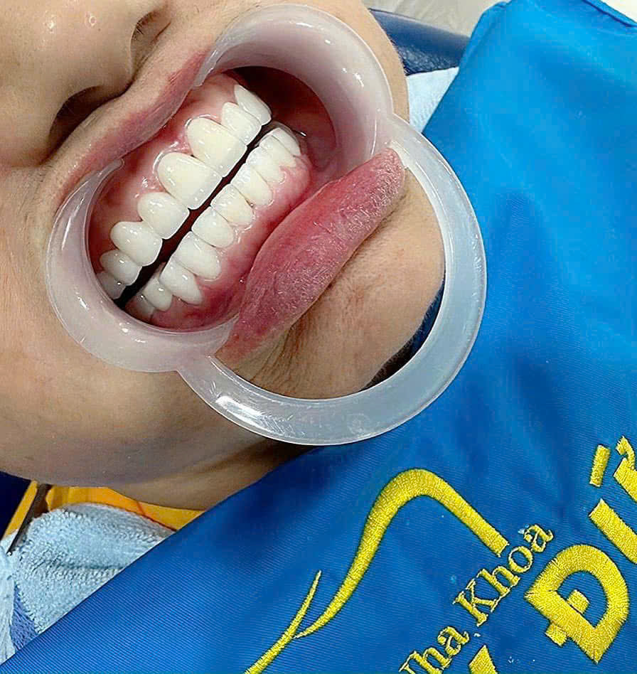 Cấy Ghép Implant